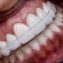 Dispositivo Intraoral